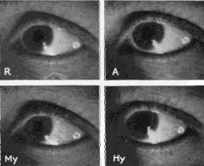 Images on the Side of the Sclera