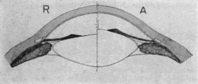 Diagram by Which Helmholtz Illustrated His Theory of Accommodation