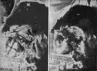 Demonstration Upon the Eyeball of a Rabbit That the Obliques Lengthen the Visual Axis in Myopia